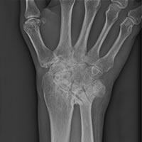 Arthritis of the wrist