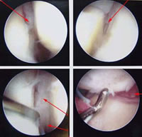 Arthroscopy of the wrist