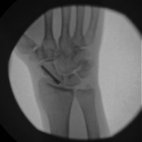 Scaphoid fracture and non-union post op