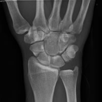 Scaphoid fracture and non-union pre op