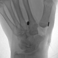 Base of Thumb Arthritis Post Op