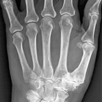 Base of Thumb Arthritis Post Op