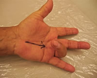 How do you know if you need trigger finger surgery?