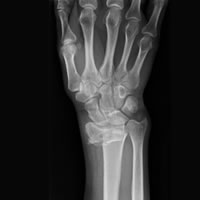 Wrist fractures pre op